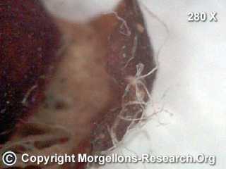Morgellons Rhizobium radiobacter2