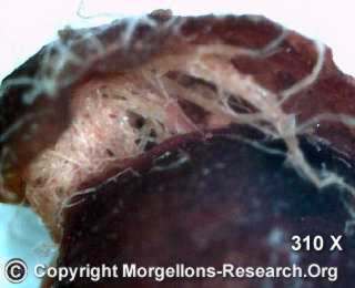 Morgellons Biofilm Agrobakterium