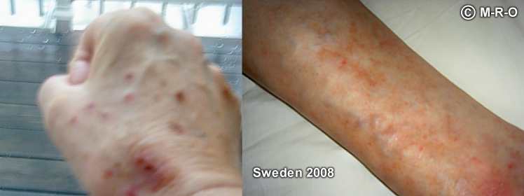 morgellons hautsymptome schweden